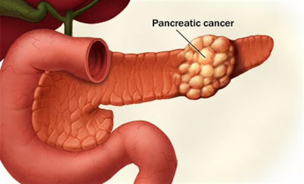 مضادات الاكسدة” قد تخفض من مخاطرالاصابة بسرطان البنكرياس