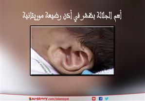 أسم الجلالة (الله) يظهر في أذن رضيعة موريتانية