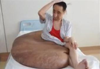 اسئصال ورم وزنه 100 كيلو من بطن صيني