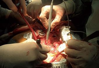 جهاز لحفظ القلب نابضا خارج الجسد