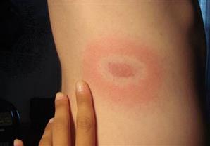 ''مرض لايم'' الغامض ينتشر في فرنسا وأوروبا وأمريكا