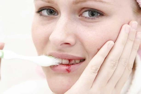 4 وصفات منزلية لعلاج التهاب اللثة