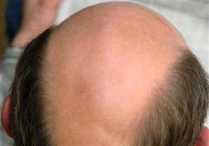 الرجال الصُلع أكثر عُرضة للإصابة بمرض خطير .. اكتشف