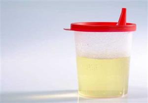 احذر من إهمال هذه المؤشرات في البول!