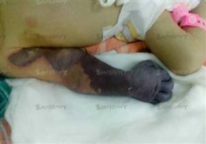 بتر يد طفل عقب ولادته بسبب سوء التشخيص- (فيديو)