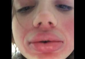 بالفيديو- أغبى طريقة لتكبير الشفتين والنتائج "كارثية"