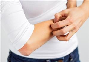 الأرتكاريا: عذاب مجهول الأسباب