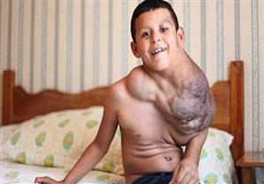 أطباء يحاولون علاج طفل من ورم ضخم بواسطة الفياجرا