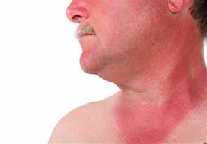 10 نصائح لعلاج حروق الجلد الناتجة عن الشمس