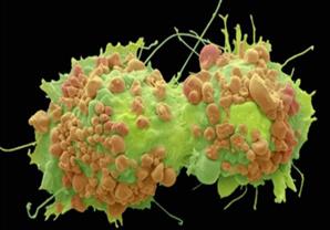 خطة بريطانية لتشخيص مرض السرطان خلال أربعة أسابيع