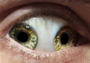 عينين في عين واحدة..حالات طبية لن تصدق مدي غرابتها!