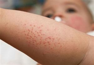 علماء: العديد من الناس يعانون من حساسية الماء