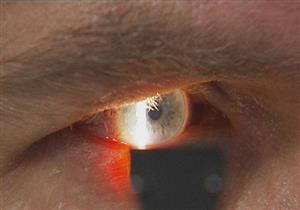  إنفلونزا العيون.. أعراضها وطرق علاجها