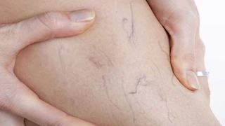 دراسة تكشف العلاقة بين الدوالي ومشكلات الذاكرة