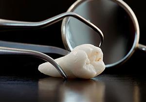 4 أسباب لخلع ضرس العقل..تعرف