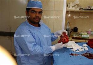 بالصور- استئصال ورم خبيث وزنه 2 كيلو من كلى مريضة عجوز بكفر الشيخ