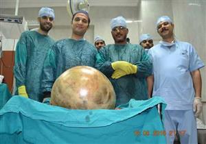بالصور – أسيوط: استئصال ورم سرطاني يزن 38 كيلو من بطن مسنة بمعهد الأورام