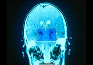 ما أسباب الإرهاق الذهني وكيف تتعامل معه؟