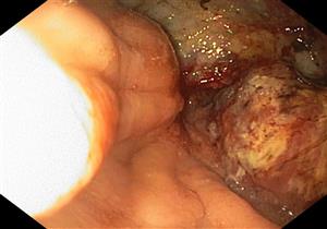 بالصور.. نجاح جراحة نادرة لمريض بسرطان المعدة بمستشفى حكومي في الإسكندرية