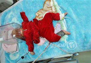 تشكيل لجنة لفحص واقعة احتراق وجه طفلة بجلسة بخار "غلاية شاي" بكفر الشيخ (صور)