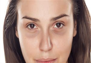   أسباب ظهور الانتفاخات والهالات السوداء أسفل العين.. وإليكِ الحل