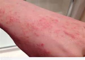 نصيحة الدكتور هاني الناظر لربات المنزل للوقاية من الإكزيما