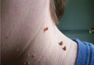 أسباب ظهور الزوائد الجلدية وطرق علاجها 