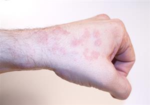 كاميرا جديدة تكشف الإصابة بسرطان الجلد في مراحله مبكرة 