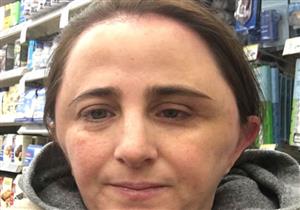 ما السبب في تضخم رأس هذه المرأة؟