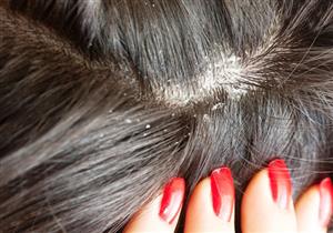 نصائح للتخلص من قشرة الشعر فى الشتاء