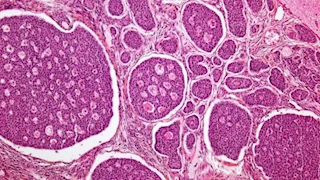 علامات تحذيرية تكشف إصابتك بسرطان العمود والبنكرياس والطحال.. احذر تجاهلها