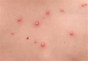 الطب الوقائي ببورسعيد: إصابة حالتين بـ"الجدري المائي" بين طلاب المدارس