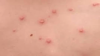 العدد وصل 24 حالة.. ارتفاع إصابات الجدري المائي بين تلاميذ مدرسة بالمنوفية