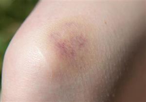 هل تظهر كدمات بشكل مفاجئ على جسمك؟.. هذه أسبابها