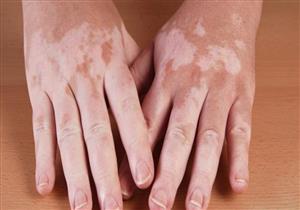  دكتور جلدية يوضح حقيقة علاج البهاق في جلسة واحدة 