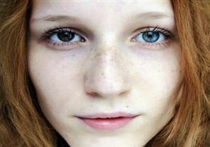  بالصور- 10 علامات للجمال هي في الأصل "أمراض واختلالات جينية"