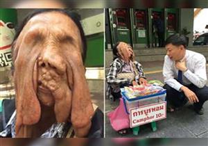 بالصور..عجوز تعاني من ذوبان جلد وجهها منذ الطفولة