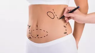 احذر ..  اضرار شفط الدهون بكميات كبيرة من الجسم