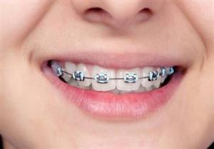 بعد التقويم.. 7 نصائح يجب اتباعها للعناية بالأسنان