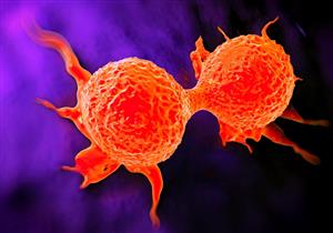 علاج جديد لسرطان الثدي باستخدام الضوء 