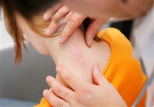 هل هناك علاقة بين الضغوط النفسية والإصابة بالصدفية؟