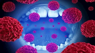 تجنبها على مائدتك.. دراسة تكشف مشروبات منتشرة تصيبك بالسرطان في الفم