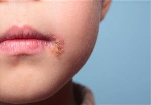 بسبب فيروس الهربس.. طبيب مناعة يحذر من تقبيل الأطفال 