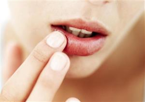 هربس الفم.. هكذا تقاوم الحبوب المزعجة حول الشفاه