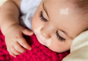 الأحذية المقلدة قد تصيبك به.. إليك أسباب مرض البهاق وطرق علاجه