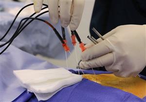 دون جراحة.. «العلاج التداخلي» يواجه هذه الأمراض