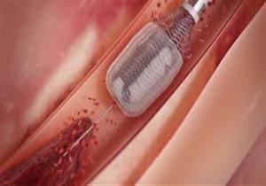 هل تعالج القسطرة انسداد القنوات المرارية؟  