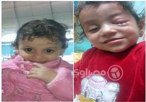 شقيقان يسكبان مادة حارقة على عين طفلة في الشرقية - صور