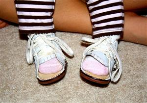 تقوس الساقين عند الأطفال.. مشكلة شائعة والحل بسيط