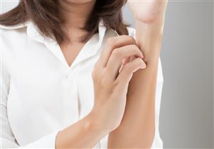 طرق آمنة وفعالة لعلاج الصدفية